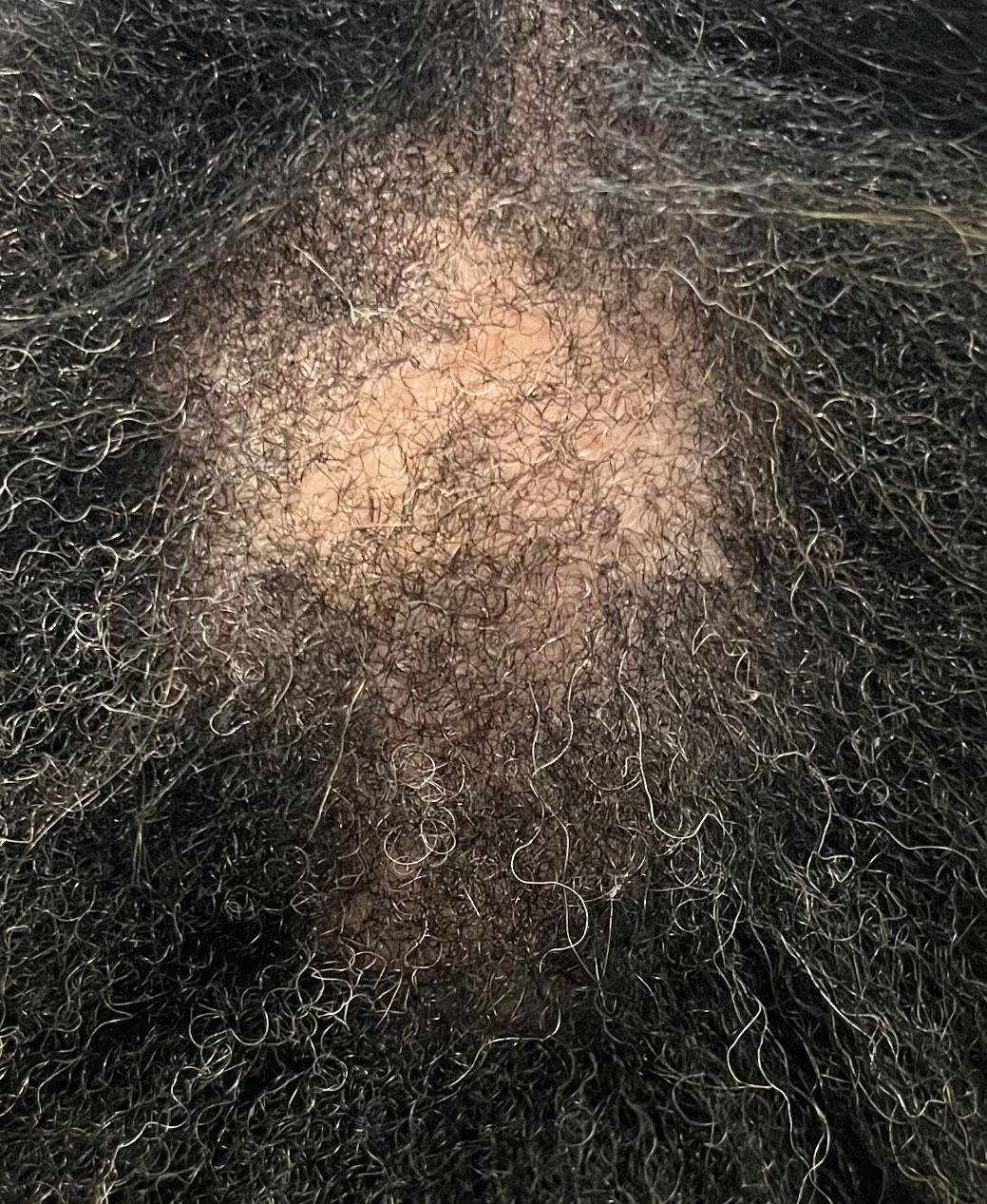 Close-up of a client's crown showing visible thinning and reduced density