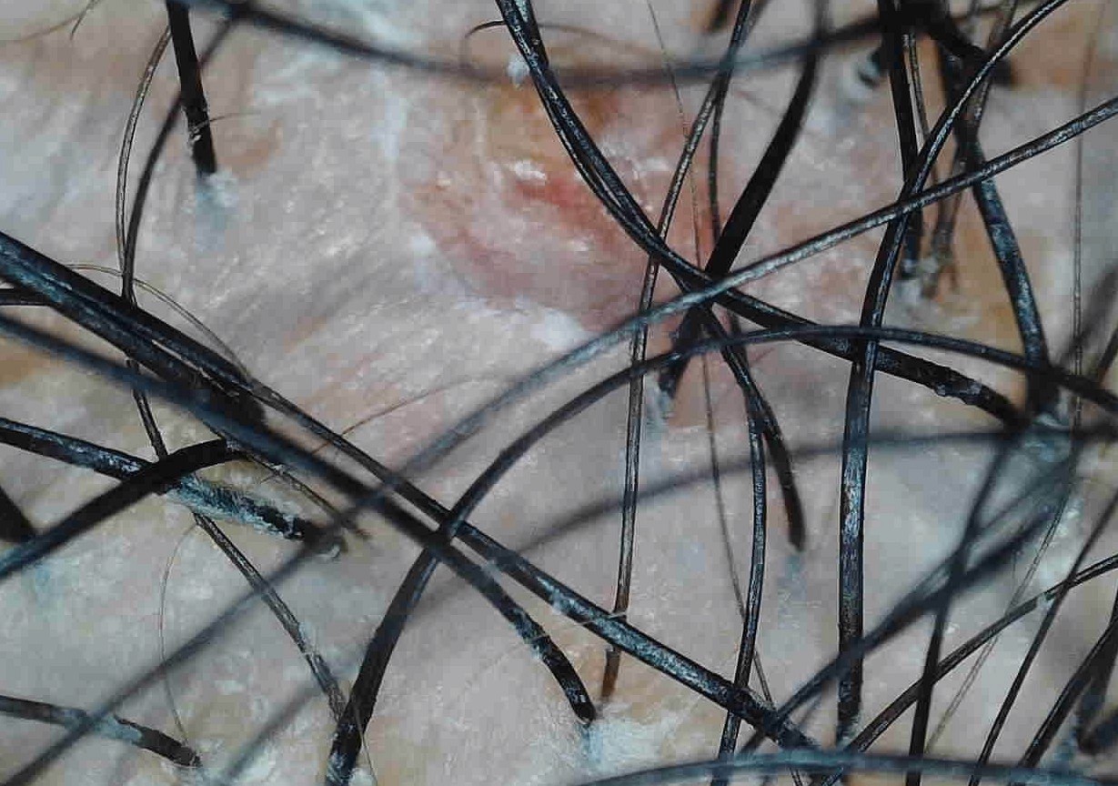 Trichoscopy close-up showing scalp inflammation and follicle-level detail