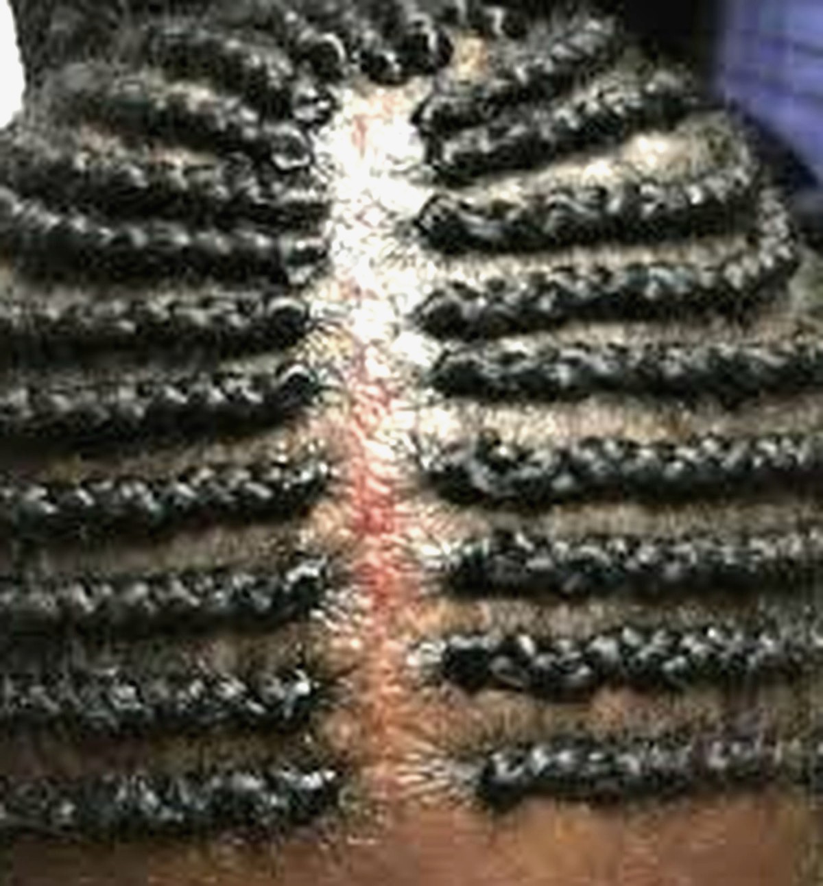 Tightly braided scalp showing visible tension and redness along the parting