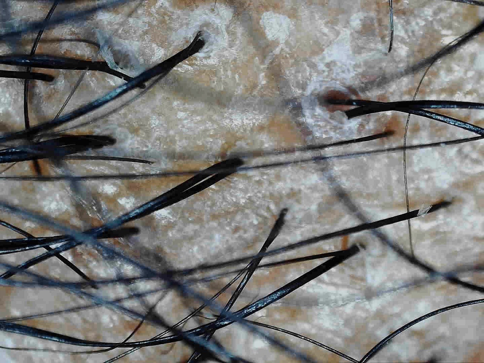 Trichoscopy view of the scalp showing follicles and surface condition