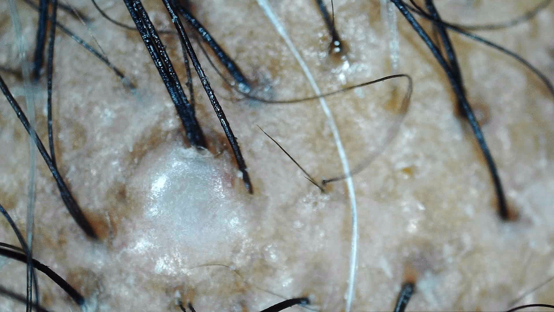 Cleaner follicular openings with less surface residue.