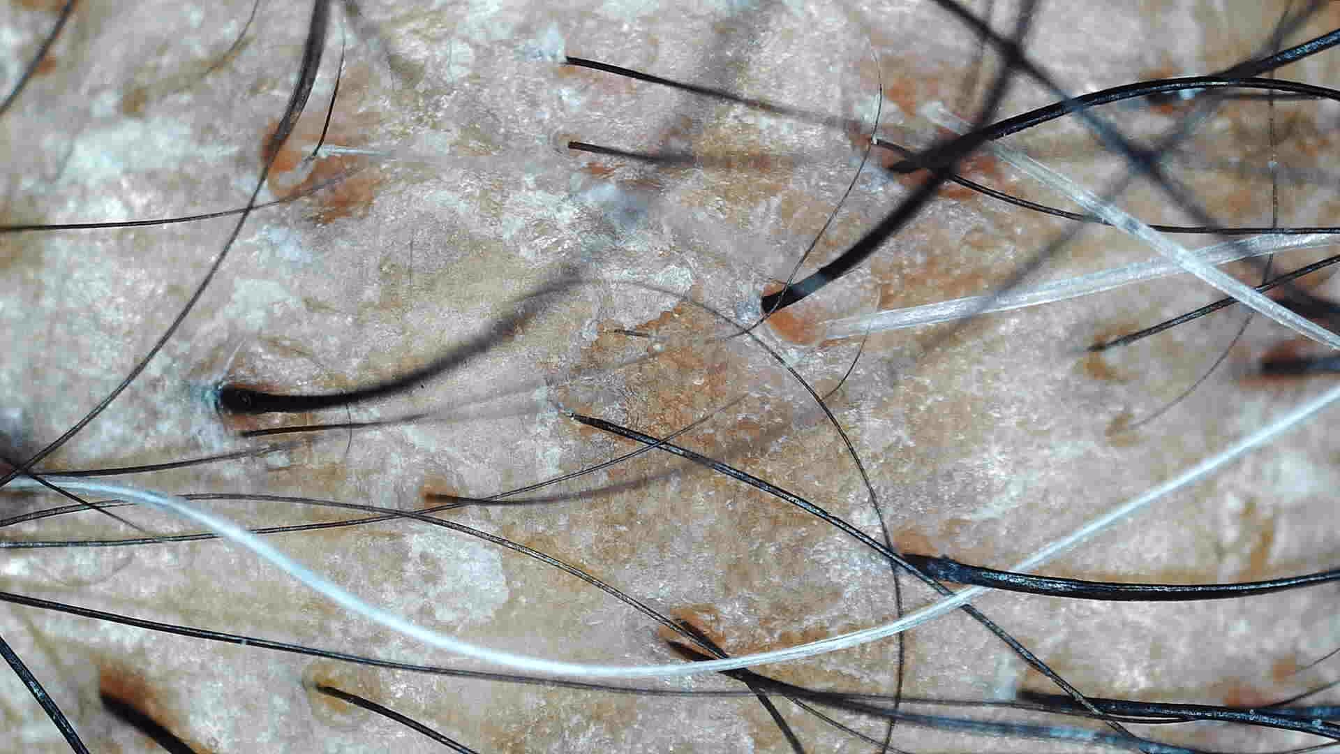 Calmer perifollicular tone with reduced scaling around the units.